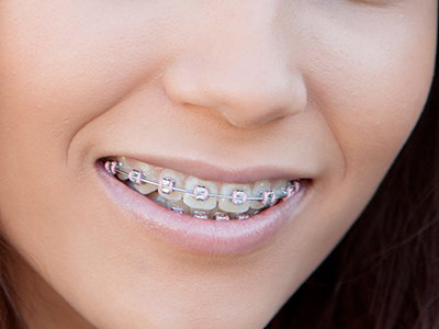 Metal Braces worn by a youth